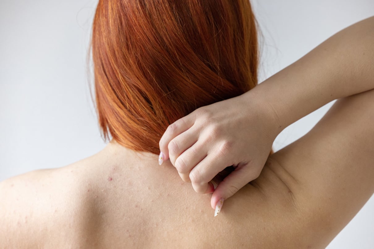 Acne body mapping explained and how to deal with unwanted body blemishes