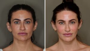 I tried facial fat grafting and after 6 months I am very happy with the results