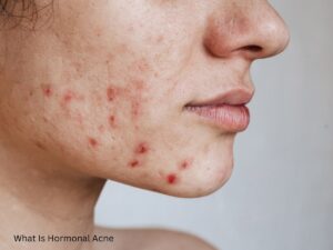 What is hormonal acne and how can I cure it?
