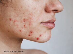 What is stress acne?