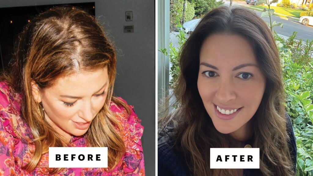 I tried everything to cure my hair loss.
