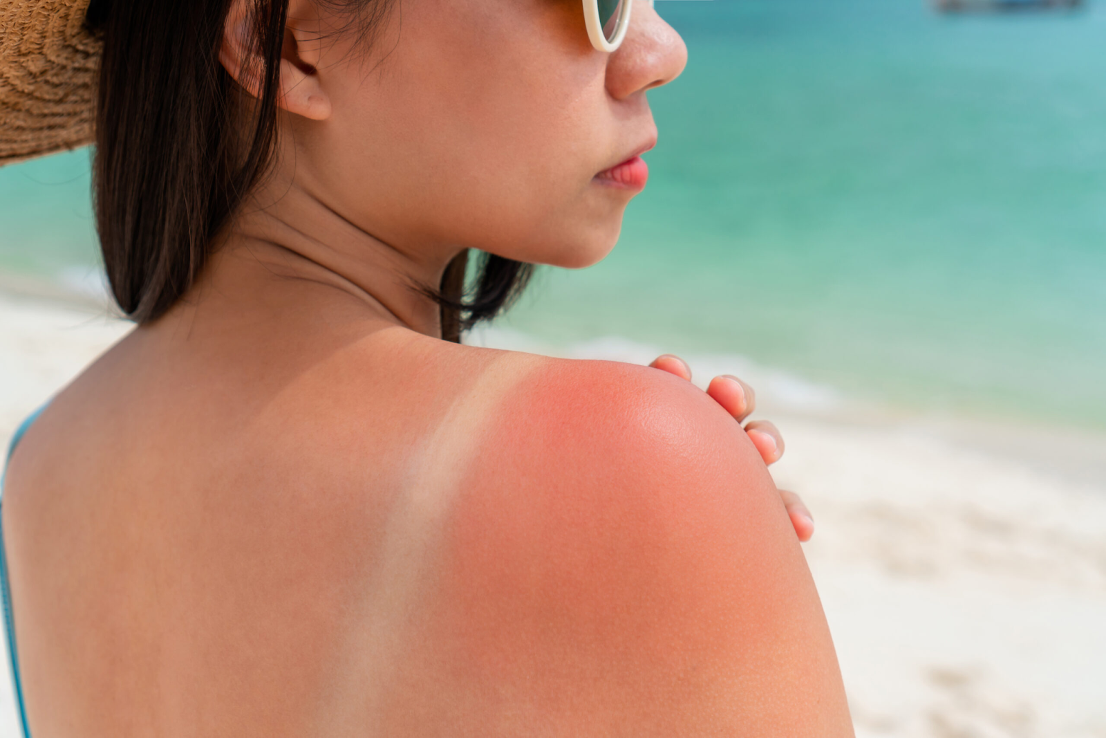 How to Treat Sunburn with Natural Ingredients: 6 Proven Things You Can Consider
