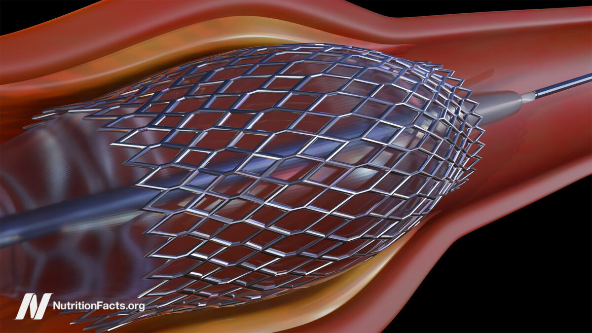 Heart Stents and their Risks