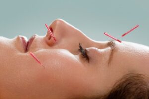 Is facial acupuncture a new Botox?