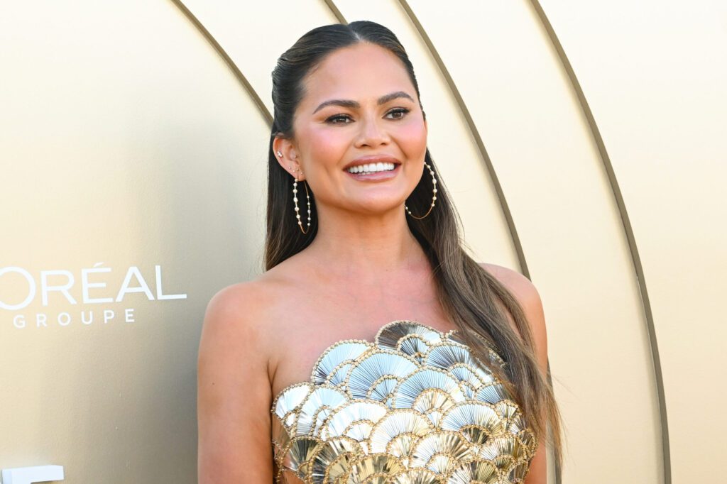 Chrissy Teigen had a hairline reduction procedure after experiencing postnatal hair loss