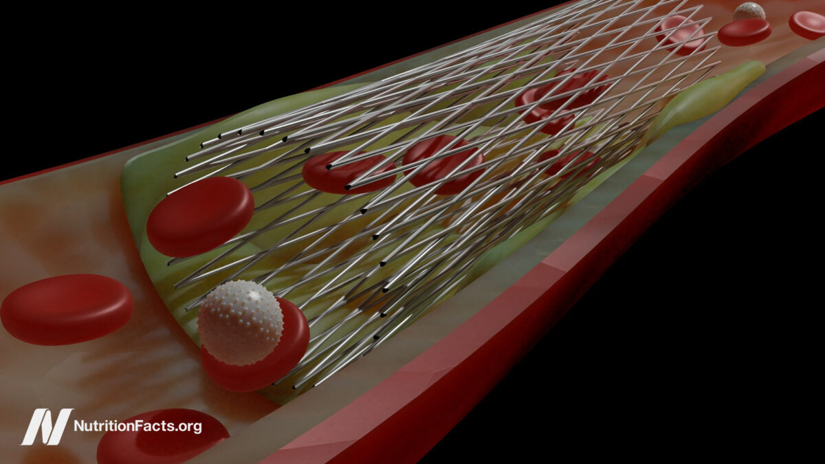 Do heart stents benefit chest pain in angina pectoris?