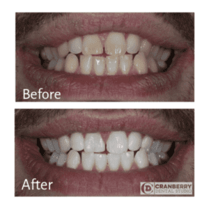 These teeth whiten the front and back photos show the power of treatment in the office
