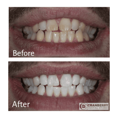 These teeth whiten the front and back photos show the power of treatment in the office