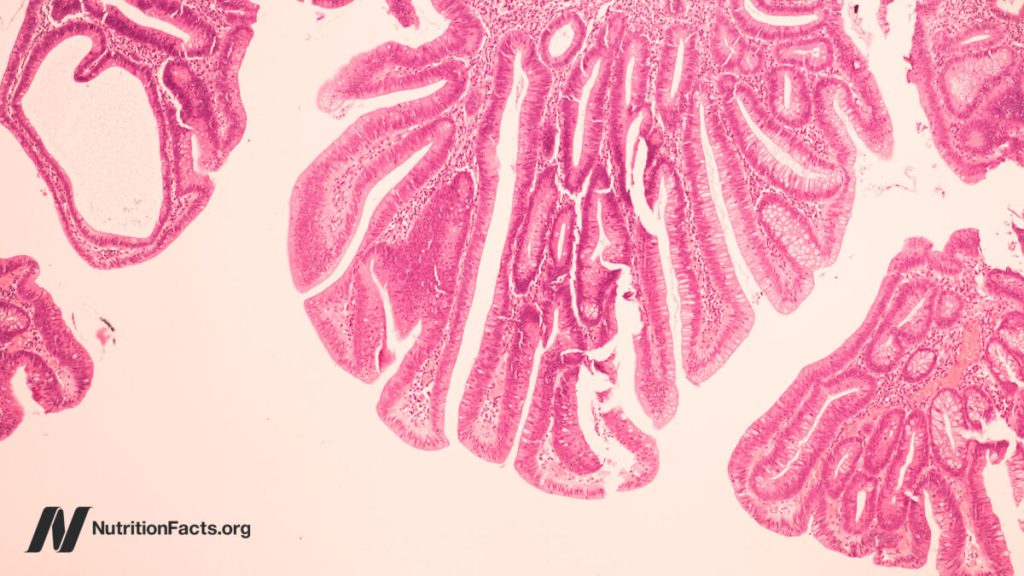 Is it possible that bovine leukemia virus causes breast cancer?