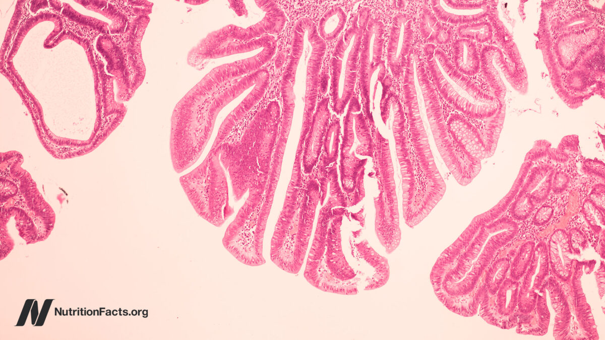 Is it possible that bovine leukemia virus causes breast cancer?